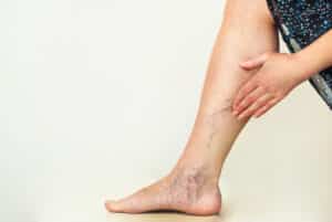 Foam Sclerotherapy