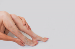 Varicose veins on a female legs.