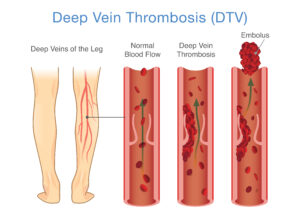 Medical,Diagram,Of,Deep,Vein,Thrombosis,At,Leg,Area.,Illustration