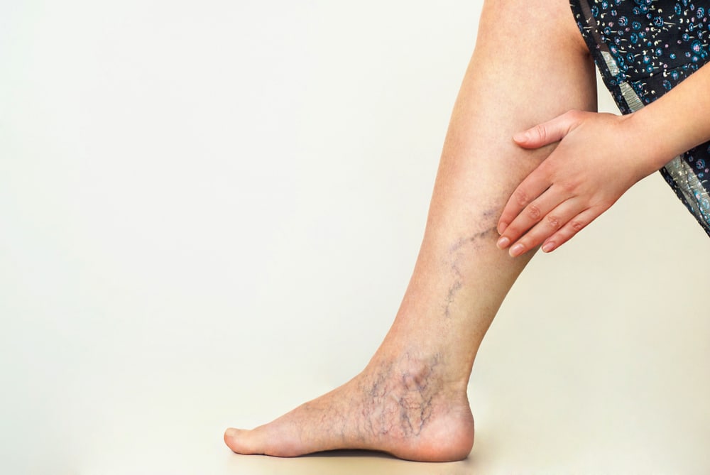 Varicose,Veins,On,The,Womans,Legs