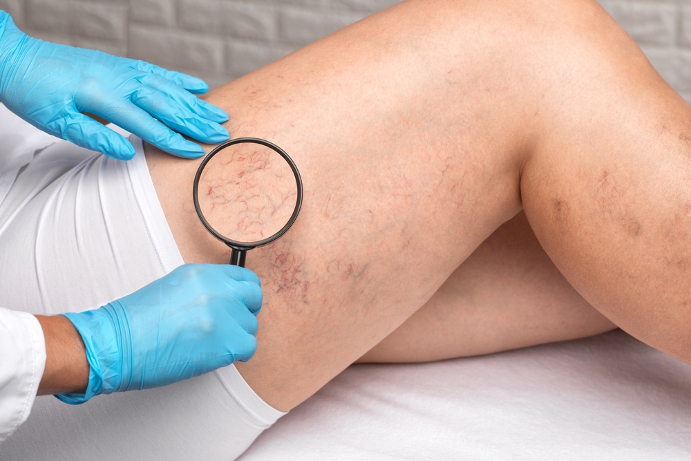 Close-up shot of varicose veins in a person's leg