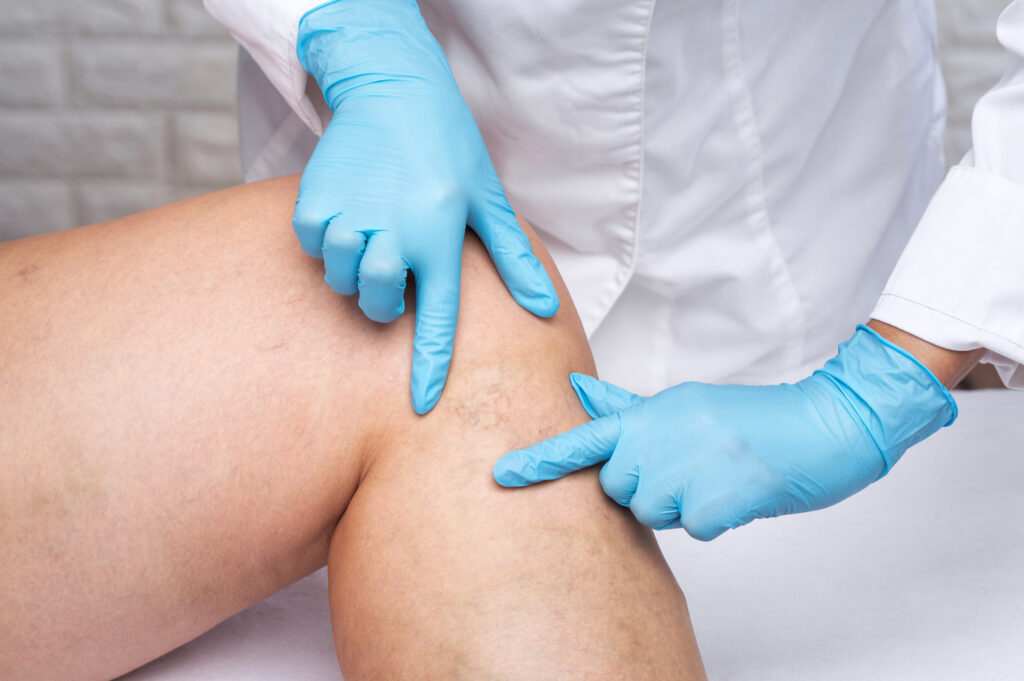 Removal of varicose veins on the legs. Medical inspection and treatment of Telangiectasia. Phlebeurysm. Doctor examining a woman's legs before laser atherectomy in Suffolk County